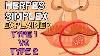 Herpes Simplex  Type 1 vs Type 2  EXPLAINED IN 2 MINUTES [upl. by Nohpets441]