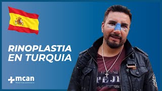 Rinoplastia en Turquía con MCAN Health [upl. by Ahsenal]