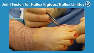 Fusion of Great Toe Joint for Hallux RigidusHallux Limitus [upl. by Nikita57]