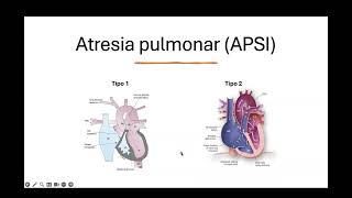 Atresia pulmonar [upl. by Aleyam647]