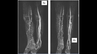 AngioRM de miembros inferiores [upl. by Leta]