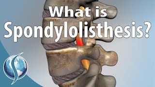 What Is Spondylolisthesis [upl. by Boffa]