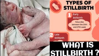 What is Stillbirth and its Classification dranshumantripathi3599 [upl. by Imuyam]