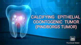 CALCIFYING EPITHELIAL ODONTOGENIC TUMOR PINDBORGS TUMOR [upl. by Phelia]