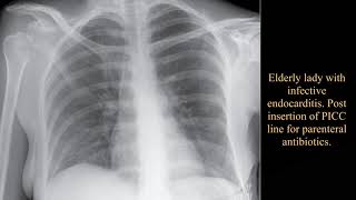 Elderly lady with infective endocarditis Post insertion of PICC line for parenteral antibiotics [upl. by Hillell]