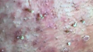 How To Remove Blackheads And Whiteheads On Face Easy 78 ✦ Dr Laelia ✦ [upl. by Maxama]