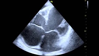 heart failure on echocardiography [upl. by Navap711]