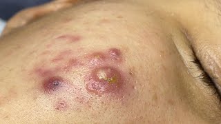 Satisfying With Loan Nguyen Spa Video 064 acnetreatment [upl. by Eyak]