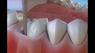 Endodoncia  Tratamento para a carie profunda en galego © [upl. by Avid324]