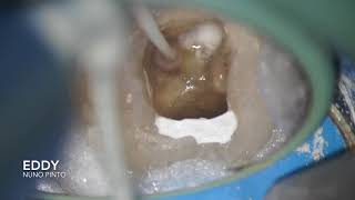 Endodontic Irrigation EDDY [upl. by Nolava]