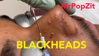 Tons of blackheads 17 minutes of extractionsBlackheads whiteheadsmilia Face and ears MrPopZit [upl. by Bik]