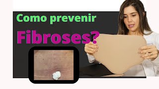 Fibroses pós lipoescutura abdominoplastia Como prevenir É importante usar talas placas [upl. by Margherita531]