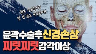 안면윤곽수술 부작용 받을 수 있는 신경손상 이상감각에 대해 [upl. by Merrily328]