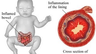 USMLE Medical Video Lectures about Necrotizing Enterocolitis by UsmleTeam [upl. by Jamel]