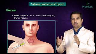 Thyroid neoplasms part 2  Follicular carcinoma of thyroid   Endocrine pathology [upl. by Asserat513]