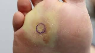 HUGE PAINFUL CORNWART REMOVAL WHAT IS IT [upl. by Aihsenat146]