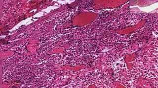 Histopathology Appendix Periappendiceal abscess [upl. by Atiuqcir]