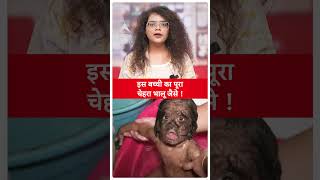 Werewolf SyndromeMalaysia की बच्ची Hypertrichosis नाम की बीमारी से पीड़ित हैजानिए डिटेल्स ABP LIVE [upl. by Hgielyak]