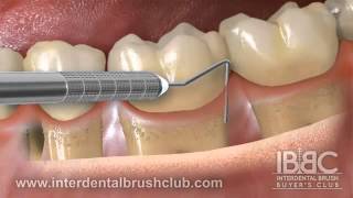 Periodontal disease causes and treatment [upl. by Wamsley]