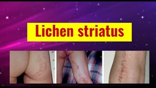 Lichen striatus overview causes features histology and management [upl. by Ardekahs686]