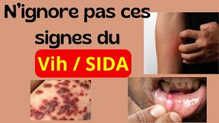 Quels sont les 13 signes du VIH  SIDA [upl. by Michiko]