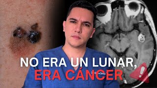 Creyó que era un lunar y resultó ser un cáncer en la piel que le causó metástasis en el cerebro [upl. by Landers]