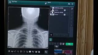 cervical spine x ray  cervical spine x ray make easy to know neck pain  pain in arm [upl. by Edia]