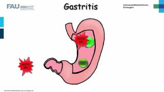 Innere Medizin ─ Gastritis [upl. by Anirac]