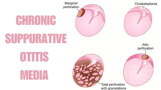 Chronic Suppurative Otitis Media  Part 3  Atticoantral Type Of CSOM [upl. by Aletha]