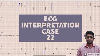 ECG MADE EASY CASE 22 EKG ELECTROCARDIOGRAM  EDUCATIONAL VIDEO [upl. by Pillyhp]