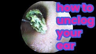 Ear picking Cleaning earwax asmr ear cleaning  how to unclog your ear  Removing cerumen [upl. by Minne350]