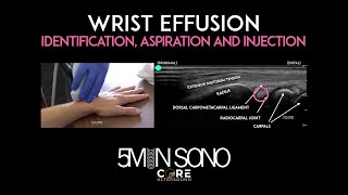 Wrist Effusion  Identification Aspiration and Injection [upl. by Einon]