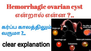 Hemorrhagic ovarian cyst in tamil  corpus luteum cyst in tamil  causes and symptoms of hemorrhage [upl. by Isola1]