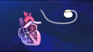 Implantatie van een tweekamerpacemaker  Medtronic [upl. by Giordano947]