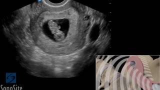 How To Pathology Ectopic Pregnancy 1st Trimester TV 3D Video [upl. by Katrine621]