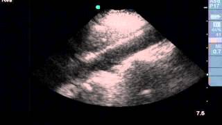 Ultrasound Evaluation of the Ab Aorta [upl. by Boaten]