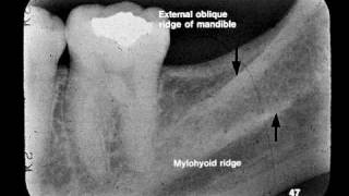 Dental Radiographic Anatomy [upl. by Rudyard]