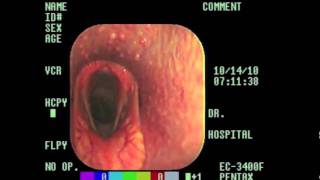 Laryngeal Hemiplegia Explained m4v [upl. by Anuska]