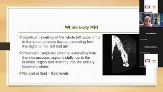 Primary Intestinal Lymphangiectasia  The treatment update Dr E Losta [upl. by Elletsirk544]