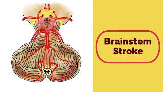 Brainstem Stroke Syndromes [upl. by Naima537]