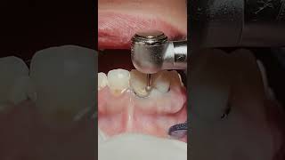 Loose gums and tooth decay repair the dentist Fill the🦷beadrepaircheapsavemoneyfillfixtooth [upl. by Homer]