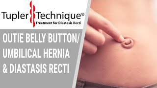 Outie Belly Buttonumbilical hernia and Diastasis Recti Julie Tupler RN [upl. by Aroled763]