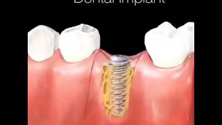 Dental Implant Procedure [upl. by Alema]