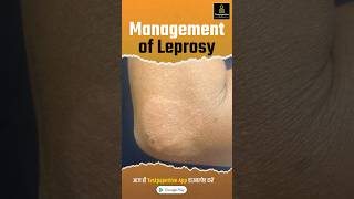 Management of Leprosy  Treatment Prevention Leprosy management treatment shortvideo nursing [upl. by Yetty545]