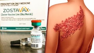 Shingles Vaccine Zostavax Is Causing What Its Designed To Prevent  The Ring Of Fire [upl. by Connett]