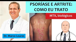 Tudo que você queria saber sobre psoríase e artrite sintomas diagnóstico e tratamento [upl. by Cooperman]