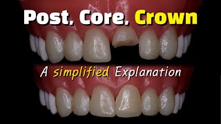 Fixing a broken front tooth with a post core buildup and crown after a root canal [upl. by Oca]