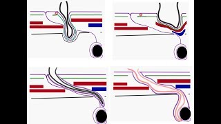 Hernias Inguinal Canal and Contents Made Simple [upl. by Nilesoj33]