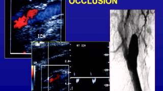 Ultrasound of the Carotid Arteries [upl. by Assilana5]