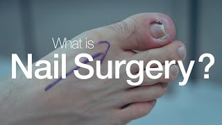 What is Nail Surgery [upl. by Tirrell149]